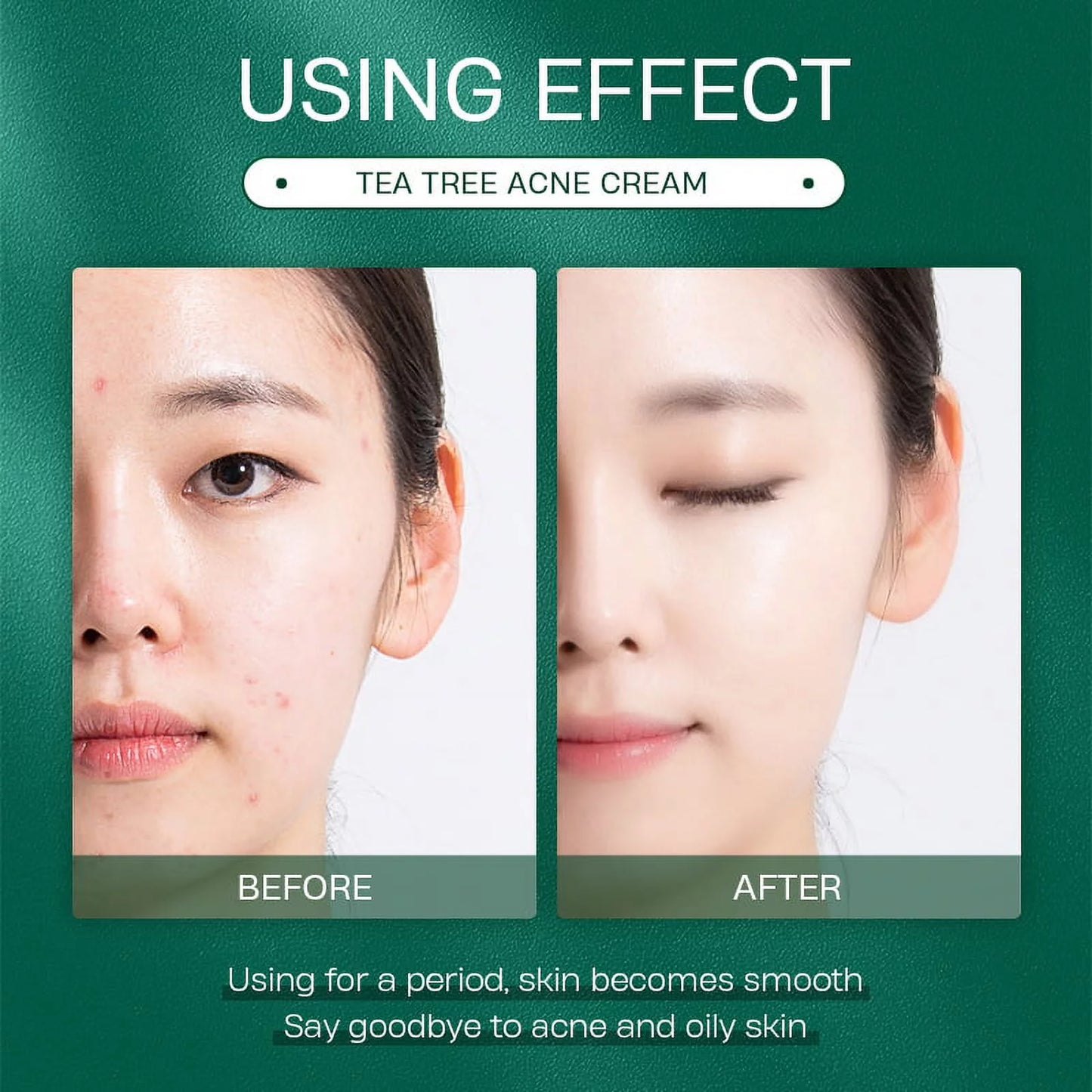 Tea Tree Oil Face Cream Acne Cream - for Oily, Acne Prone Skin, Extra Soothing & Nourishing Non-Greasy Botanical Facial Moisturizer, Acne Removal, Gently Repair for Acne Skin, Cystic Acne, Pimple & Re